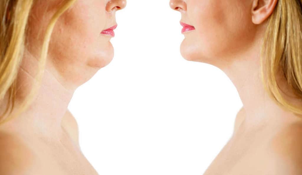 Double Chin treatment Berkshire before and after results