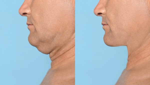 Which Non-Surgical Treatments Work Best for Jowls and Loose Skin Berkshire?