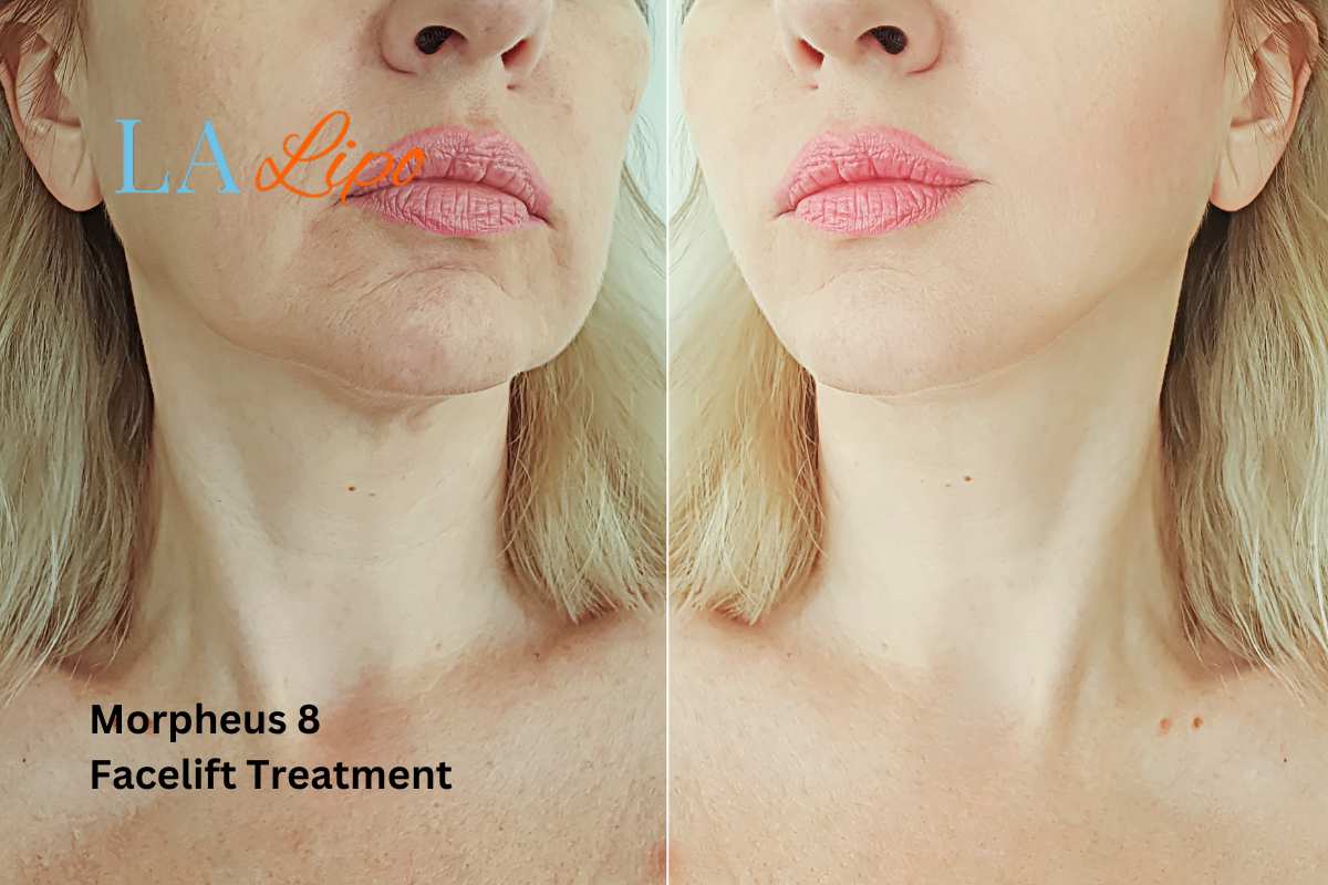 Turn back time with Morpheus8 Treatment Berkshire