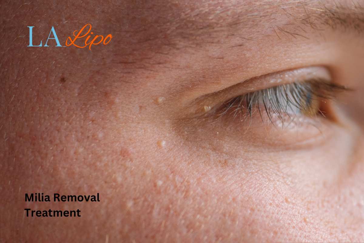 Cryopen Milia Removal: Is It the Easiest and Safest Option Berkshire?