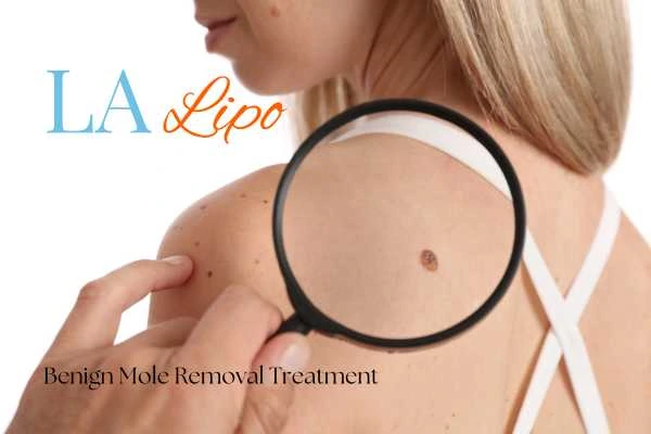 Why getting moles removed Berkshire can boost your confidence!