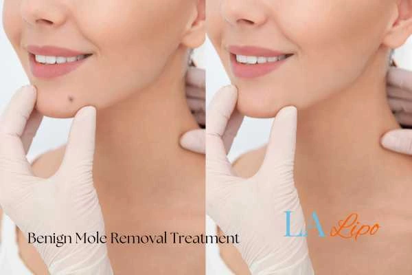 woman's before and after mole removal Berkshire results