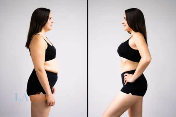 image of woman before and after results of LA-EMS Body Sculpting Berkshire to help treat Diastasis recti