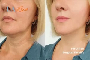 hi-fu for wrinkles Berkshire before and after results