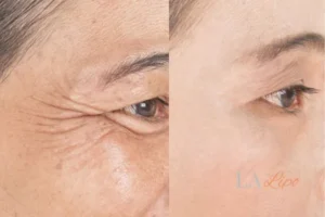 Before and after results of woman - HI-fu wrinkles reduction treatment Berkshire