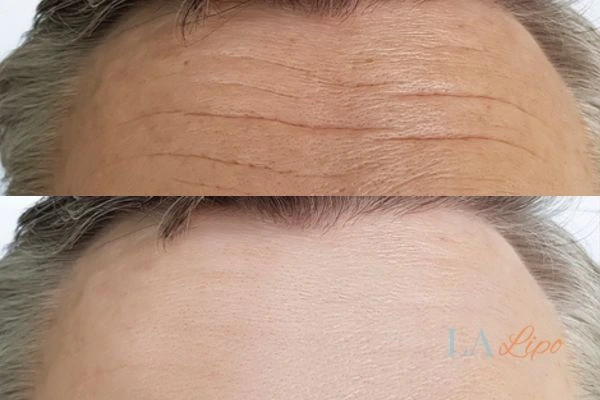 results of HIFU Berkshire on mans forehead to help reduce lines and wrinkles