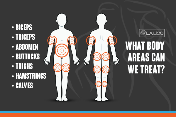 Graphic to show areas you can have LA-EMS Body Sculpting Berkshire treatment.