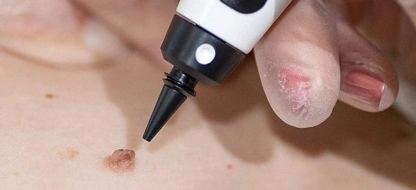 skin tag removal using cryopen Berkshire