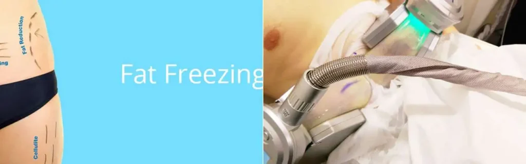 Fat freezing Berkshire on multiple areas of the body