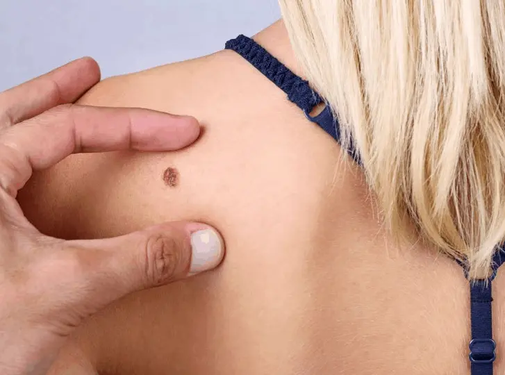 woman having mole removal Berkshire consultation before treatment.