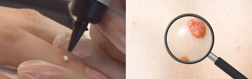 Cryopen for mole removal Berkshire - speak to our team today!