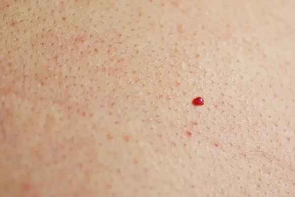 close up of a cherry angioma Berkshire