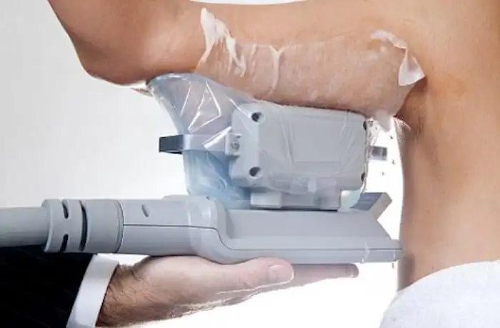Picture of fat freezing Berkshire on the upper arms.
