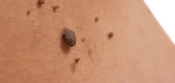 image of a skin tag Berkshire