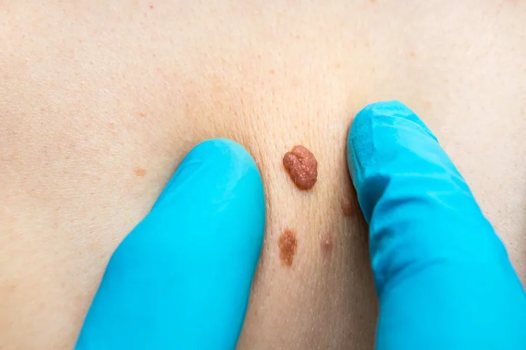 Consultant examining a skin tag Berkshire