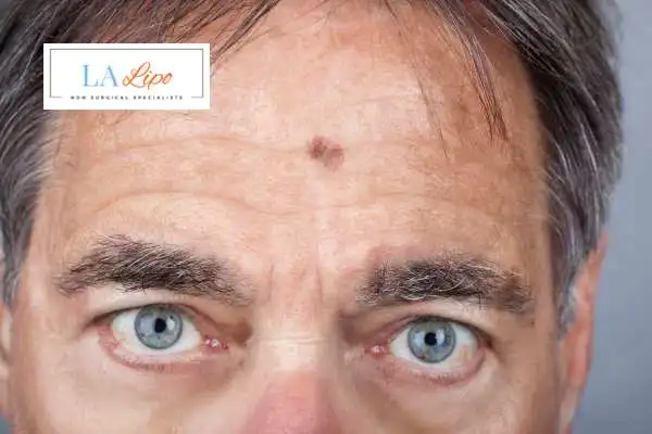 Solar Lentigo Removal Berkshire image of man with mark on his forehead