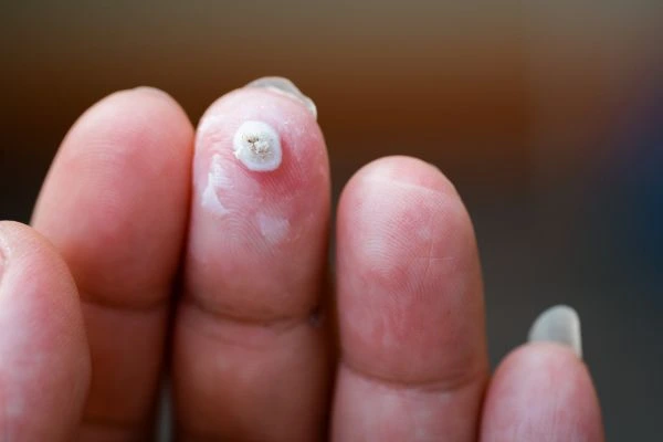 wart on person finger - cryotherapy to treat from LA LIPO Berkshire