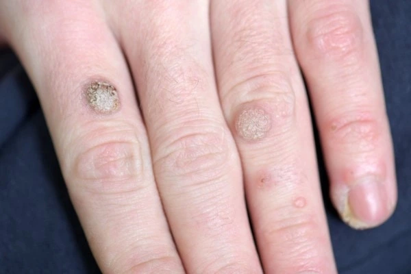 photo of warts on person hand - see wart removal Berkshire from LA LIPO