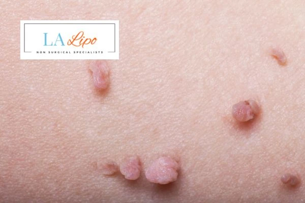 Does cryopen skin tag removal Berkshire hurt? Find out now call our team today!