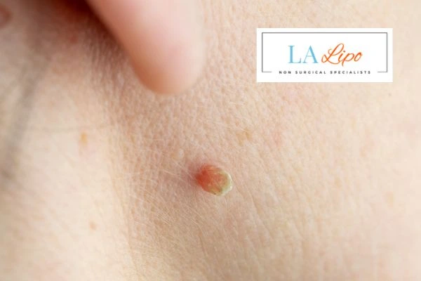 Book skin tag removal Berkshire today speak to our team now!