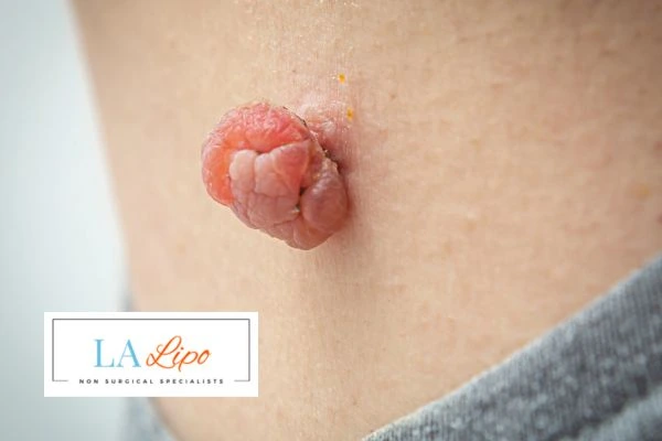 Interested in skin tag removal Berkshire? Concerned about the pain? Find out more today!