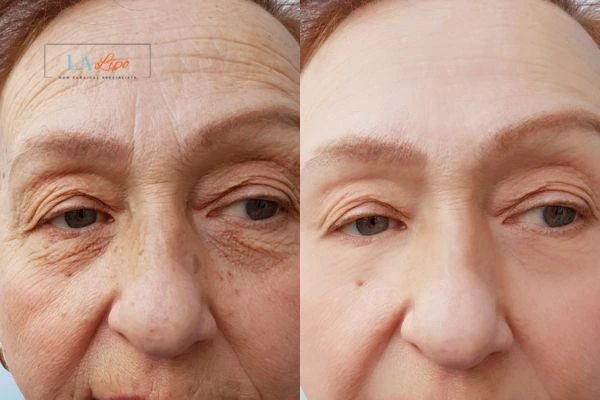 The powerful benefits of Morpheus8 Treatment Berkshire - Call Our team today!