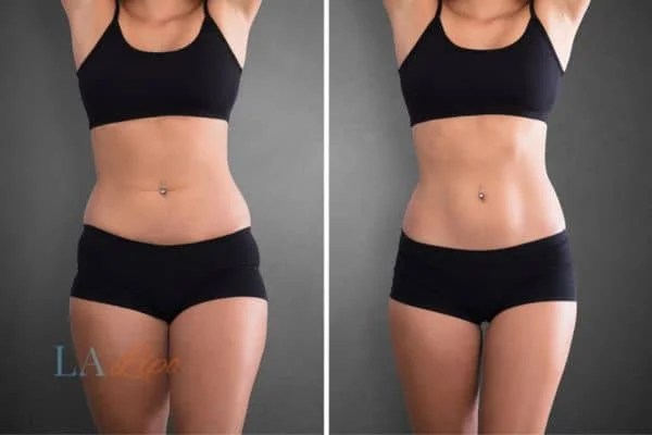 before and after results of non-surgical treatment to help a woman's body image and mental health Berkshire