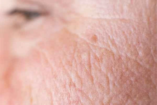 close up picture of a woman's face showing an age spot Berkshire