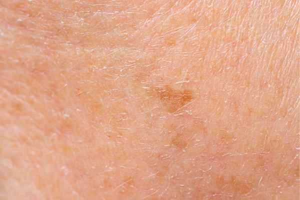 close up picture of age spots Berkshire