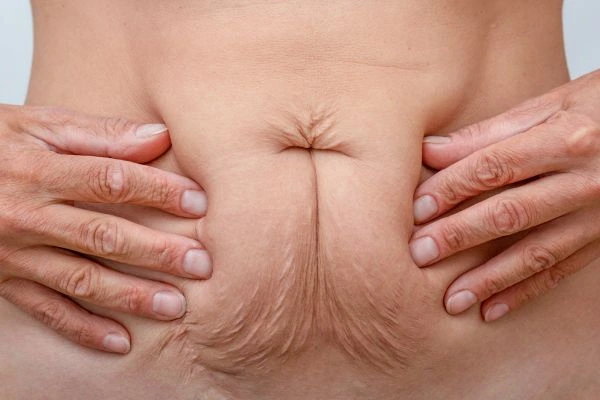 Image of a woman's stomach with loose skin - example of skin tightening Berkshire options