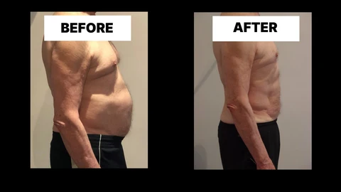 What Symptoms Can Diastasis Recti Cause in Men? Weak Core, Back Pain and Poor Posture Berkshire